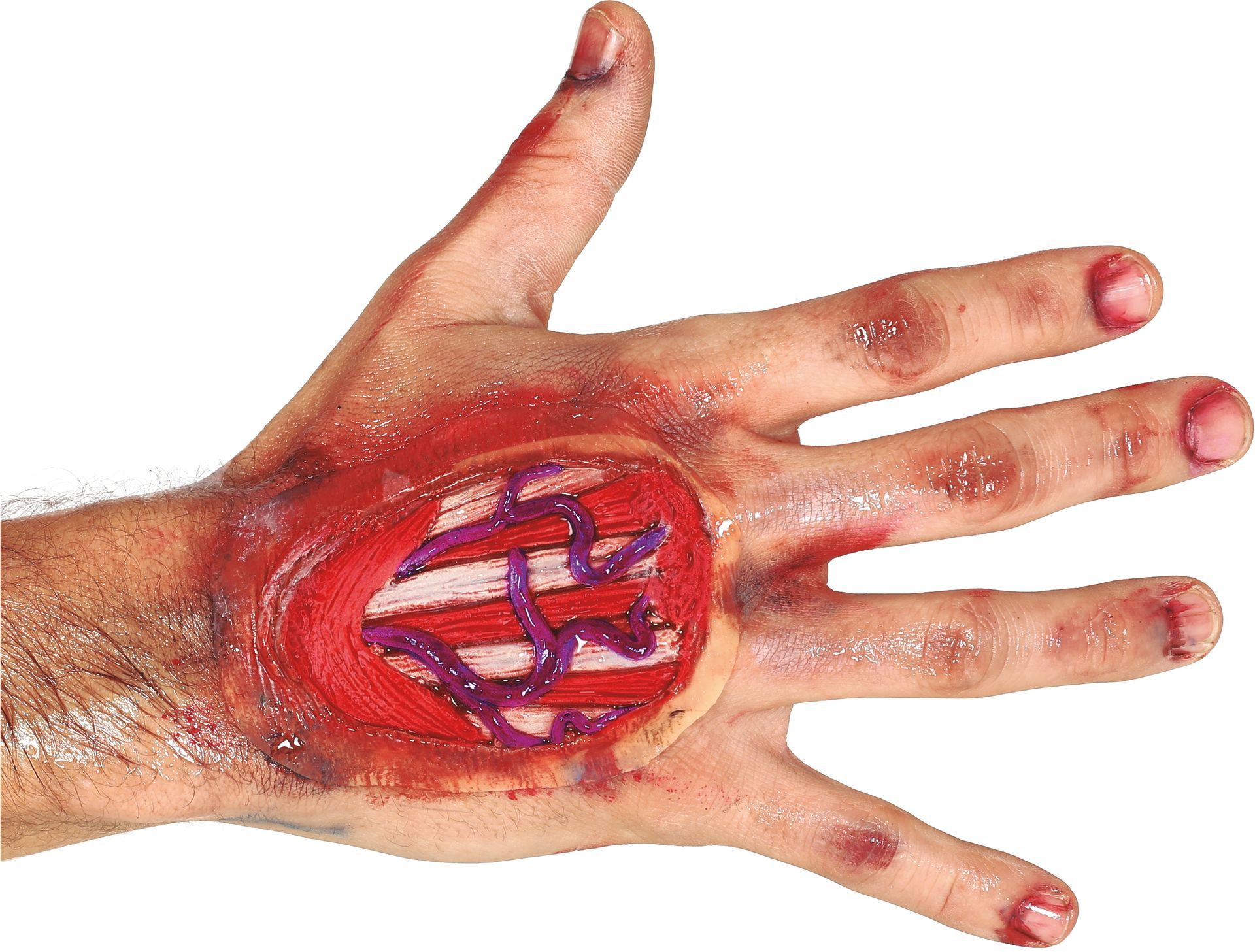 Bloederige Peeswond Hand