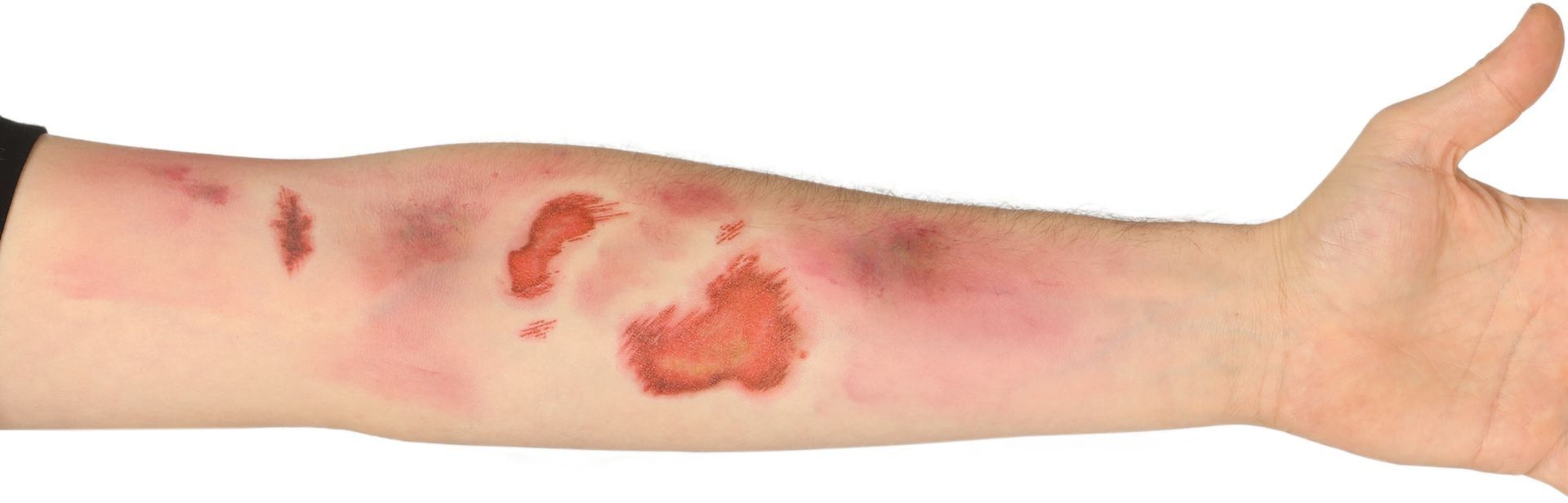 Set Van Schaafwonden Stickers